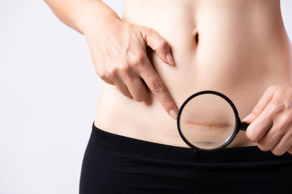 blizna po cesarskim cięciu mobilizacja blizn fizjoterapia po cięciu cesarskim Warszawa – mobilizacja blizny